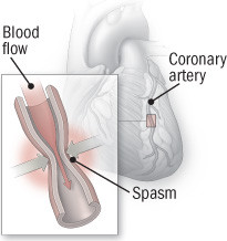 illustration of coronary artery vasospasm