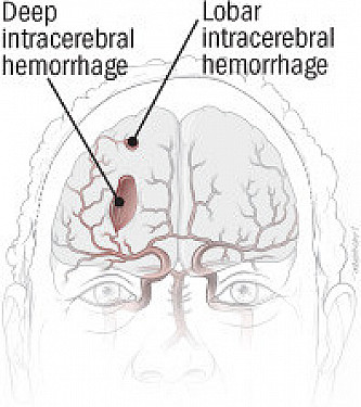 Study suggests caution on statins after a bleeding stroke featured image