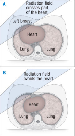 Radiation for breast cancer is linked to narrowing of the coronary arteries