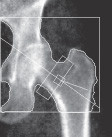 Bone mineral density testing: How often?