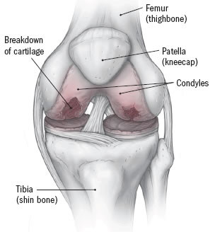 Managing osteoarthritis of the knee