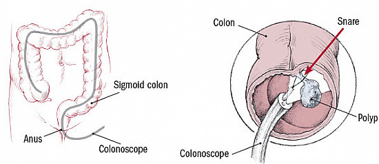 Colonoscopy now easier to tolerate featured image