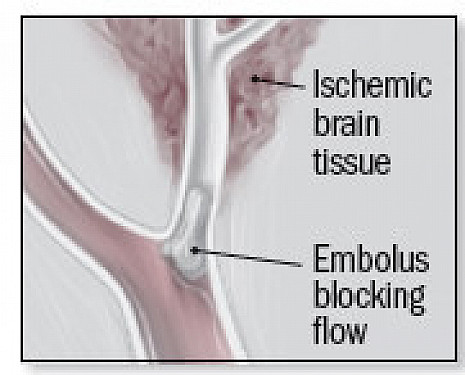 Women are at higher risk for stroke than men. featured image