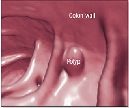 Making smart screening decisions: Colon cancer screening featured image