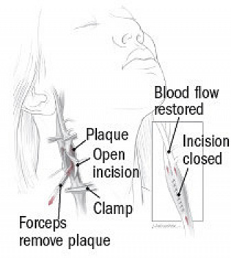 Carotid stenosis treatments compared featured image