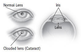 Normal vs. Cataract Lens