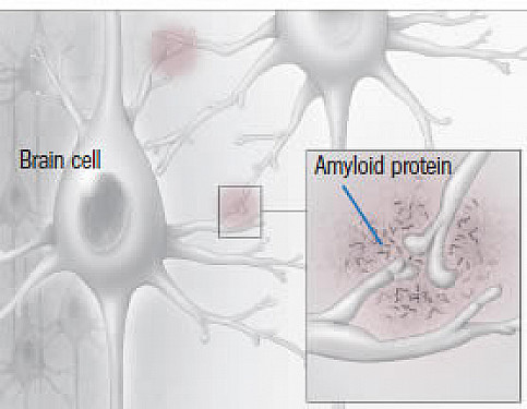 Alzheimer's drug update featured image