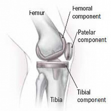 How to get ready for a new knee featured image