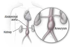 Screening savvy: You're likely at low risk for abdominal aortic aneurysm