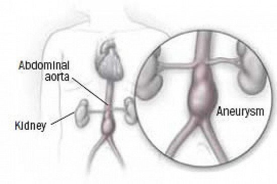 Screening savvy: You're likely at low risk for abdominal aortic aneurysm featured image