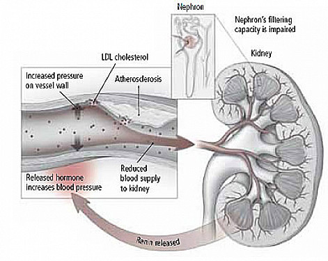 Prevent kidney disease to prevent heart disease featured image