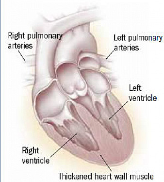 When high blood pressure affects the arteries to the lungs featured image