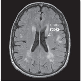 Reduce your risk of silent strokes