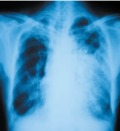 Heart attack risk rises after a bout of pneumonia 