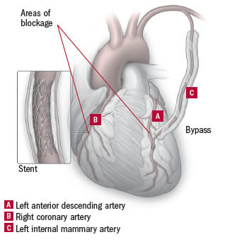 Bypass plus angioplasty: The best of both worlds? 