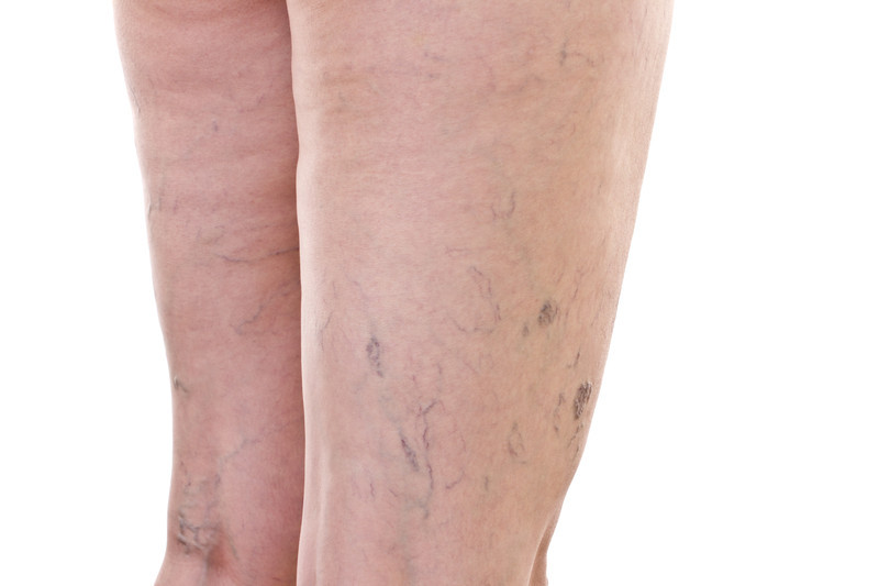 Vanquishing varicose veins