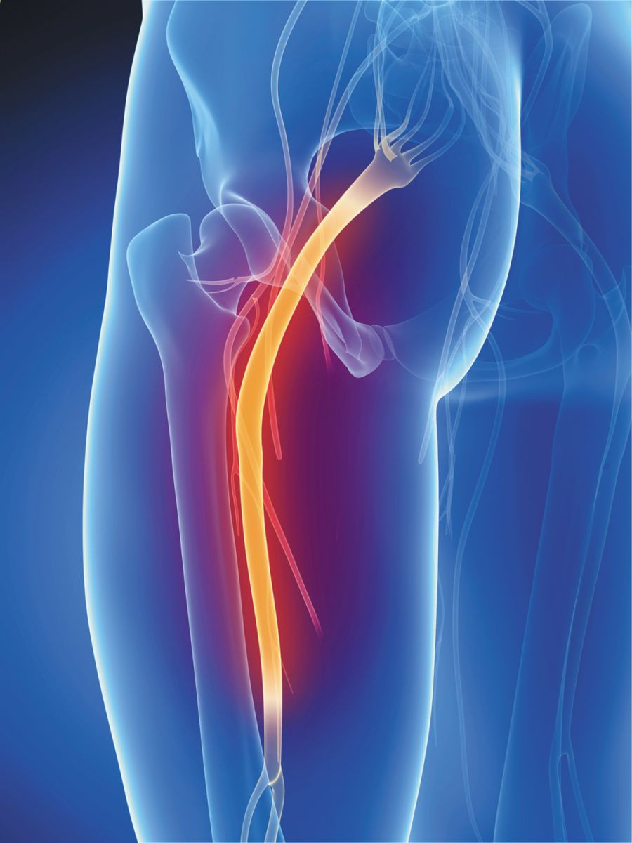 Taming the pain of sciatica: For most people, time heals and less is more -  Harvard Health