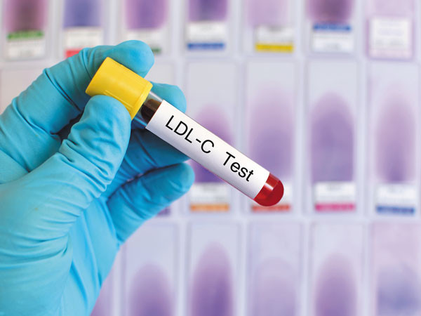 cholesterol test