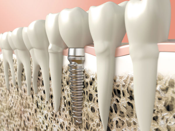 dental health implant teeth