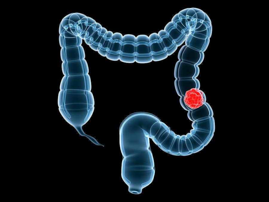 colon cancer screening