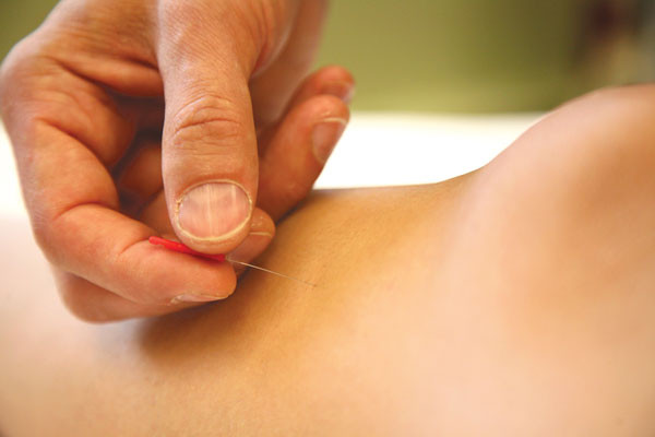 Modern acupuncture linked to constipation relief