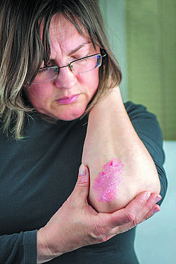 Ask the doctor: Does psoriasis raise diabetes risk? featured image