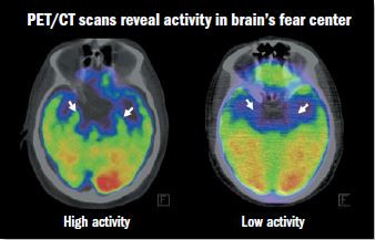 Uncovering the link between emotional stress and heart disease