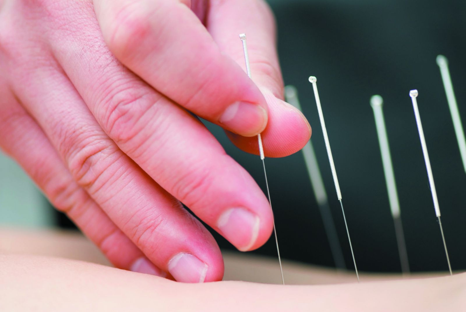 The finer points of acupuncture