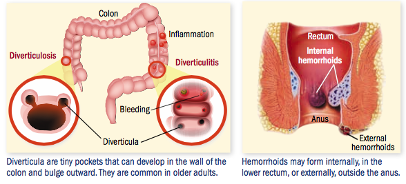 internal hemorrhoid bleeding