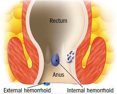 internal hemorrhoid bleeding