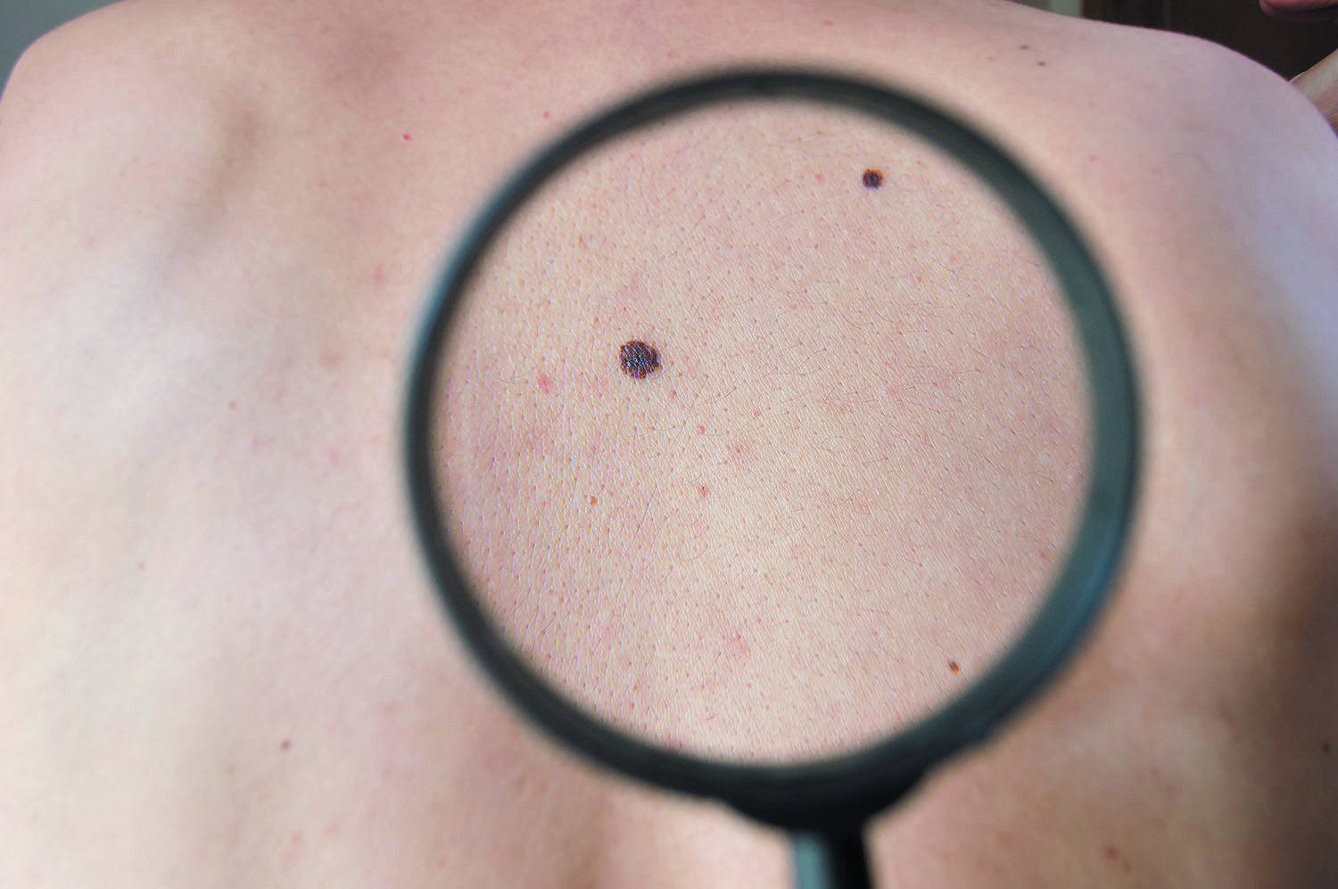 Melanomas don’t always arise from existing moles