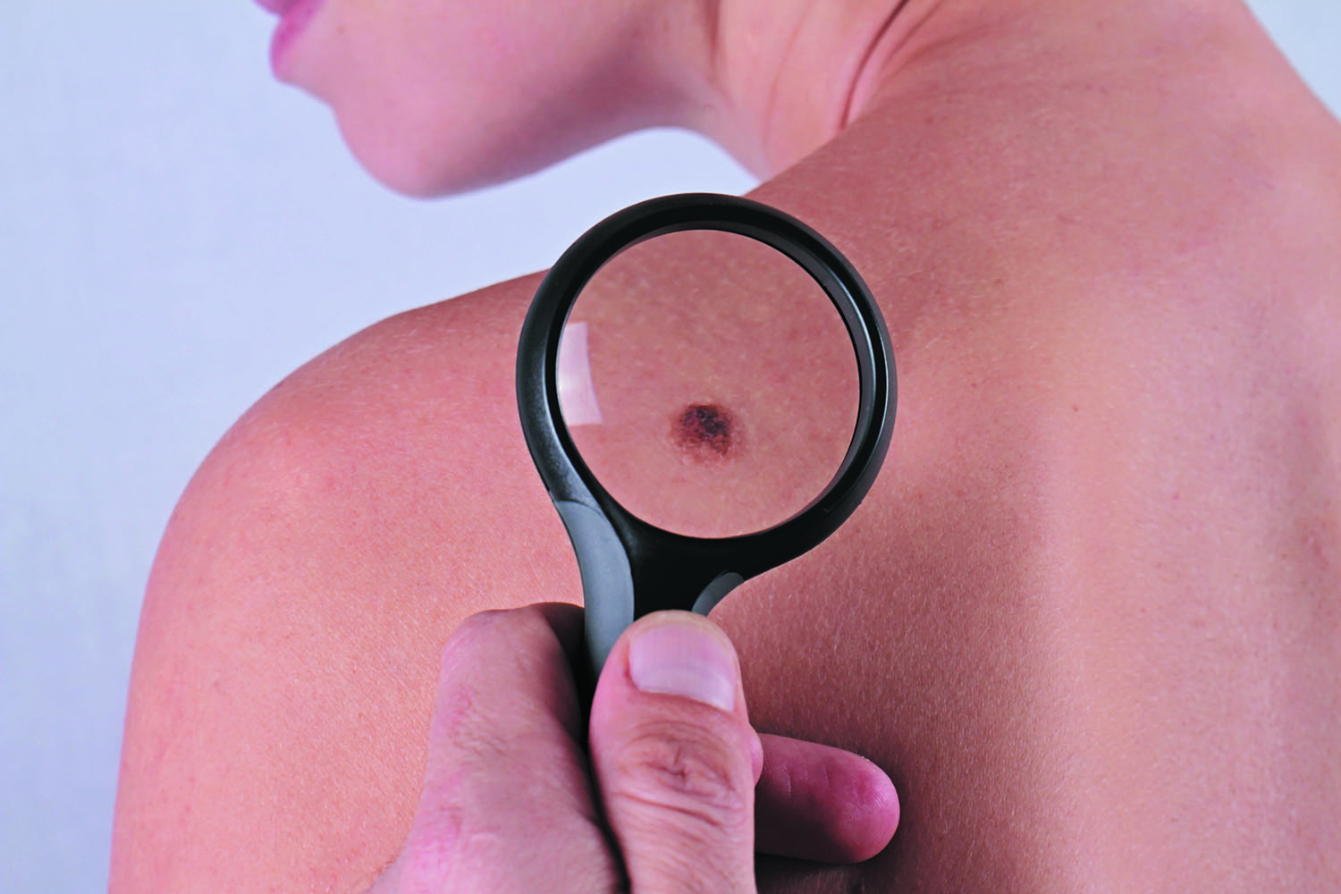 Most melanomas start as new spots