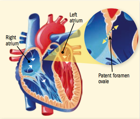 After a stroke with no clear cause, a heart repair may be in order -  Harvard Health