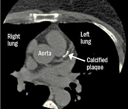 When you look for cancer, you might find heart disease featured image