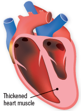 What is cardiomyopathy?