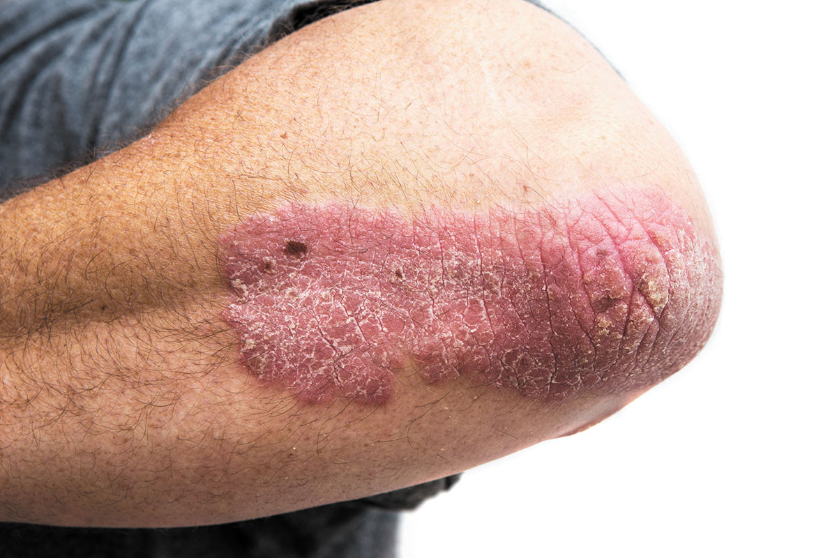 how long does psoriasis flare up last)