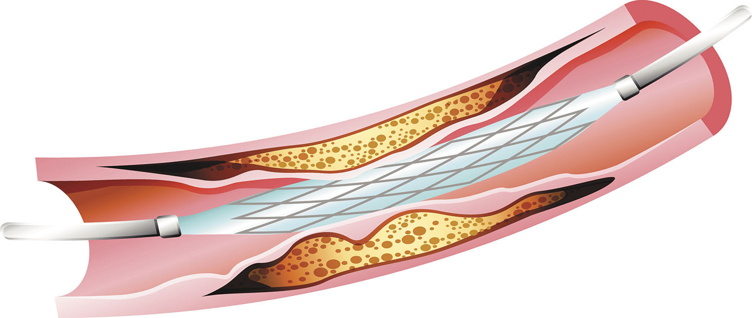 When do you need a heart stent?