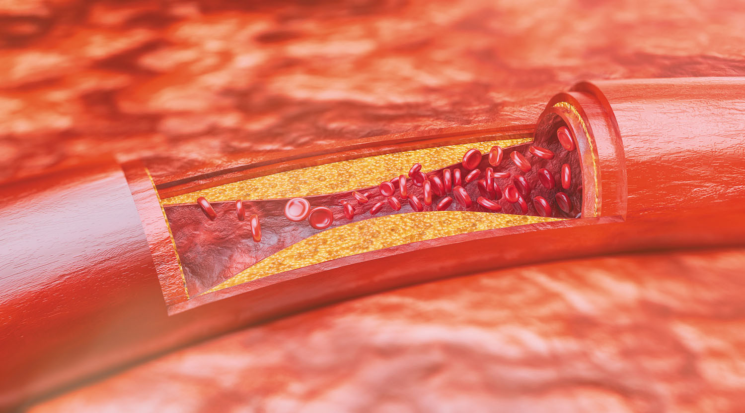 Avoiding atherosclerosis: The killer you can't see