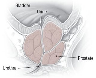 what size of prostate is dangerous