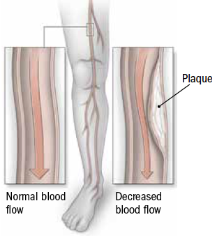 A leg up on peripheral artery disease