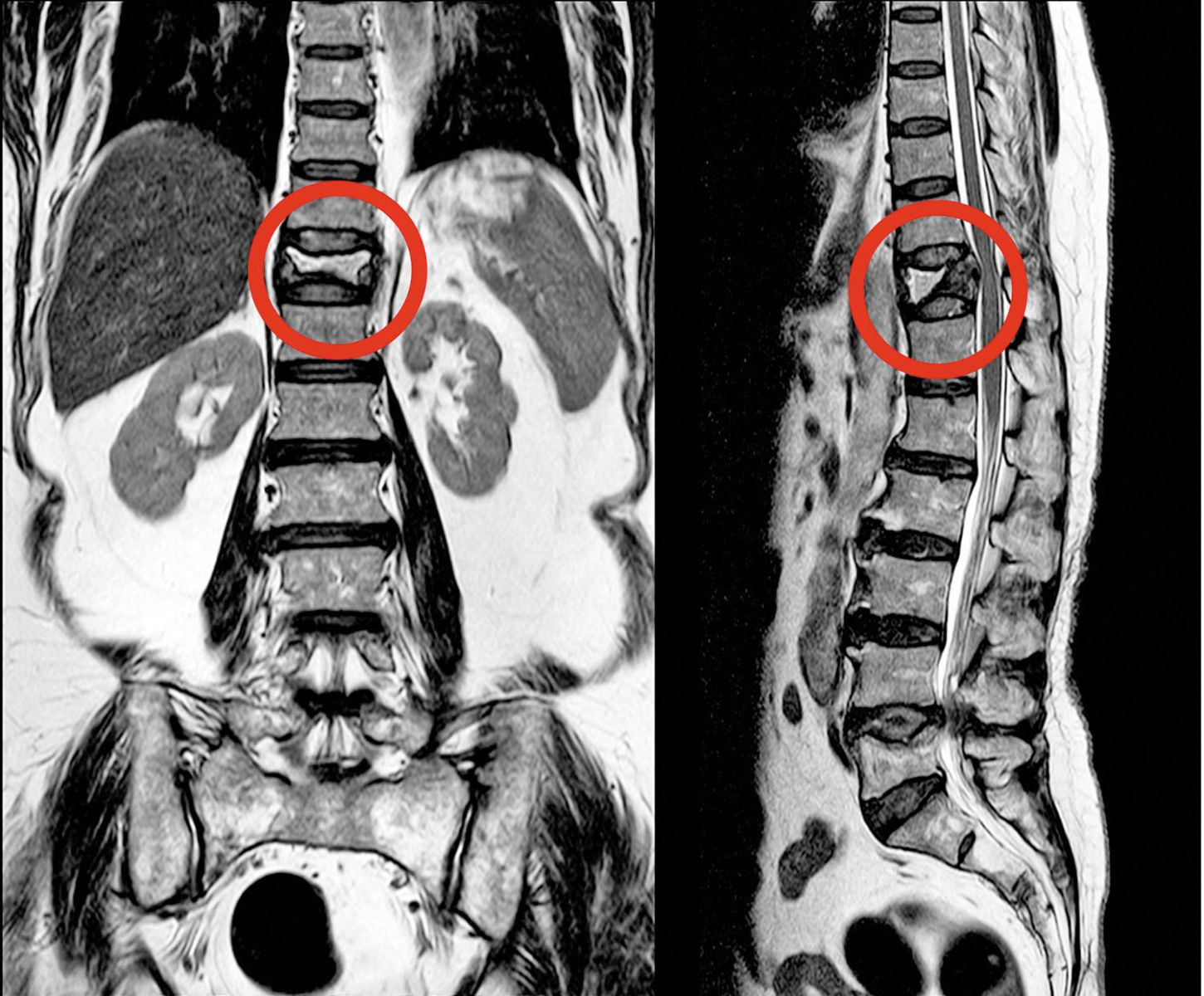 Broken Back X Ray