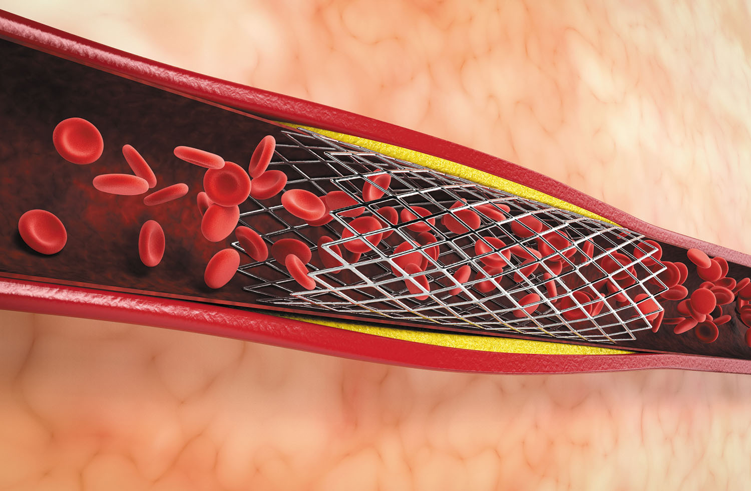 Blood thinners after a stent: How long?