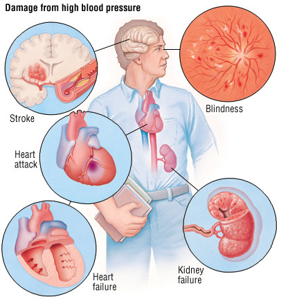 blood pressure symptoms headache)