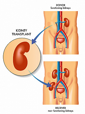 Kidney Transplant featured image