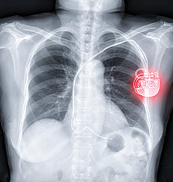 Pacemaker featured image