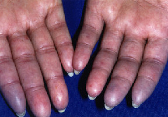 Scleroderma Harvard Health 1309