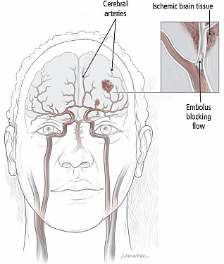 Stroke Overview featured image