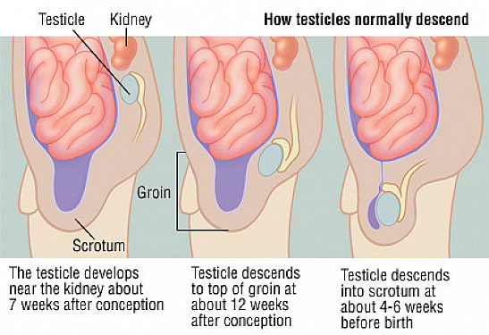 Undescended Testicle Cryptorchidism Harvard Health