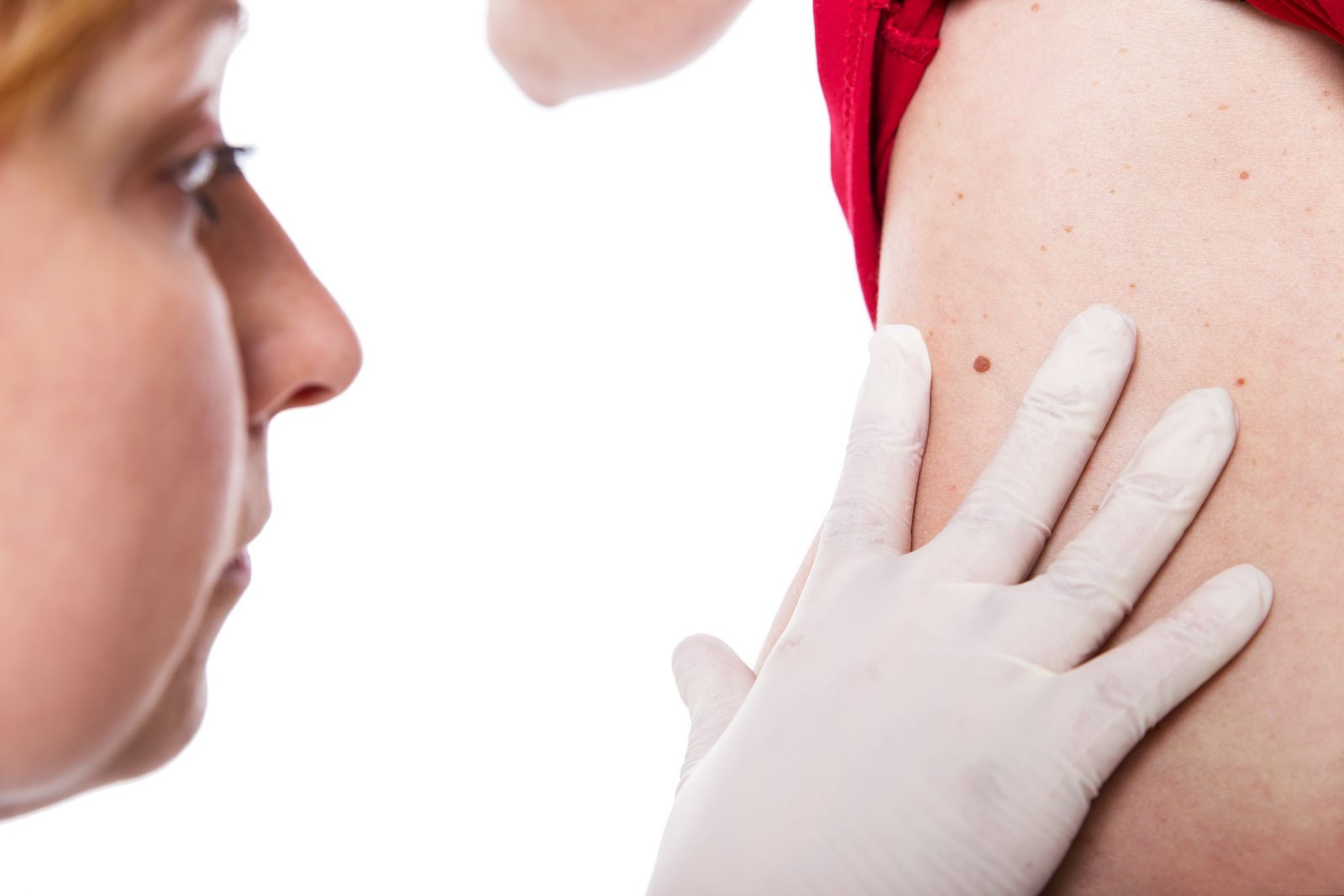 Melanoma — early detection and treatment are critical