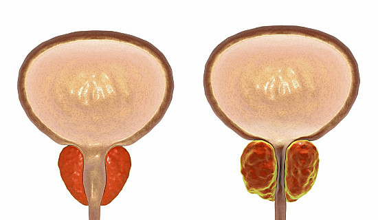 An enlarged prostate gland and incontinence featured image